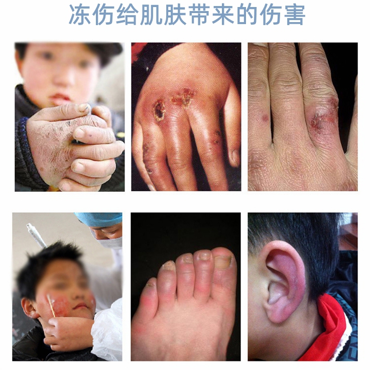 Оригинальная мазь от обморожений Чжоу с маслом из арбуза Шулинсен для ухода и восстановления кожи рук, ног и ушей при трещинах, зуде и отеках 10г/уп.