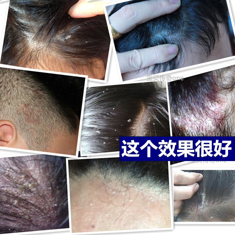 Шампунь Пинокон с угольным дегтем Xinzekan Zeta – против перхоти, снимает зуд, удаляет клещей, контролирует жирность и акне